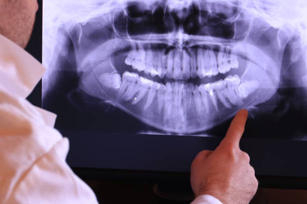 Best Emergency Wisdom Tooth Extraction in Corinth, TX